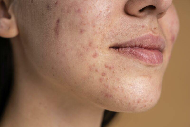 confident young woman with acne close up