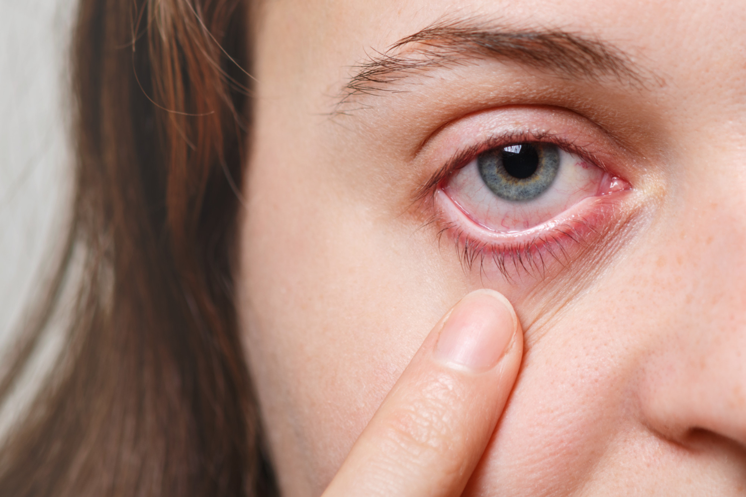 Läs mer om artikeln Eksem runt ögonen – Symtom, orsak och behandling