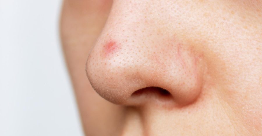 acne på näsan