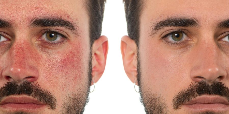before-after-treatment-rosacea-man-s-face
